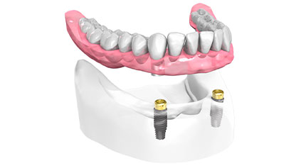Remplacer toutes les dents - Cabinet dentaire du Dr Ludovic Ache Paris 16