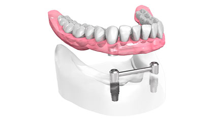 Remplacer toutes les dents - Cabinet dentaire du Dr Ludovic Ache Paris 16