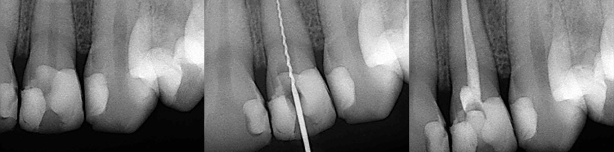 Endodontie - Cabinet dentaire du Dr Ludovic Ache Paris 16