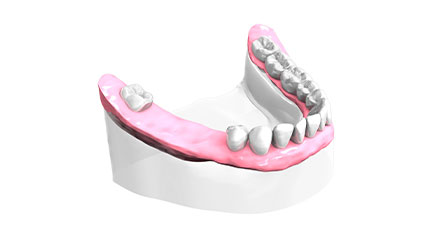 Remplacer des dents - Cabinet dentaire du Dr Ludovic Ache Paris 16