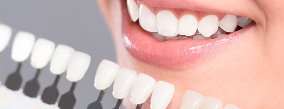 Facettes dentaires - Cabinet dentaire du Dr Ludovic Ache Paris 16