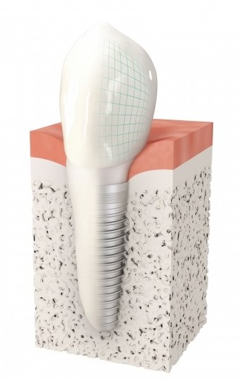 Implant dentaire - Cabinet dentaire du Dr Ludovic Ache Paris 16