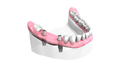 Remplacer des dents - Cabinet dentaire du Dr Ludovic Ache Paris 16