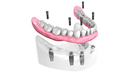 Remplacer des dents - Cabinet dentaire du Dr Ludovic Ache Paris 16